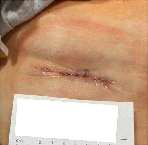 Patient 1 on day of surgery.