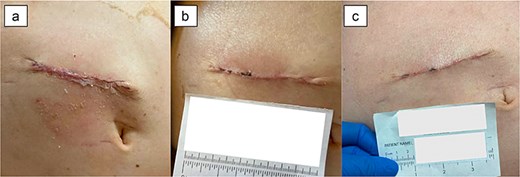 Patient 3 on (a) POD 4, (b) POD 13, (c) POD 26.