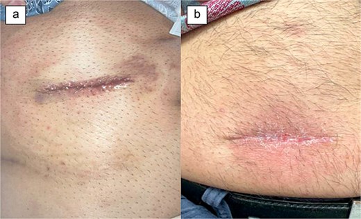 Patient 4 on (a) day of surgery, (b) POD 48.