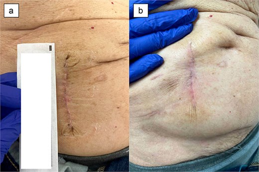 Patient 5 on (a) POD 27, (b) POD 46.
