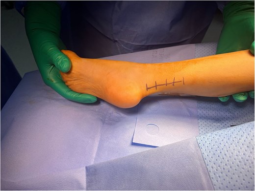 Maximum dorsiflexion before Achilles tendon Z-lengthening.