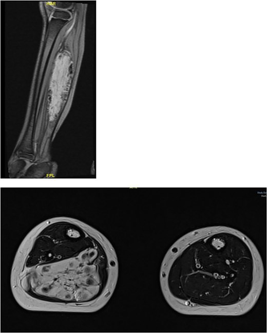 Large, lobulated intramuscular soft tissue vascular lesion with multiple calcified phleboliths, suggesting intramuscular hemangioma.