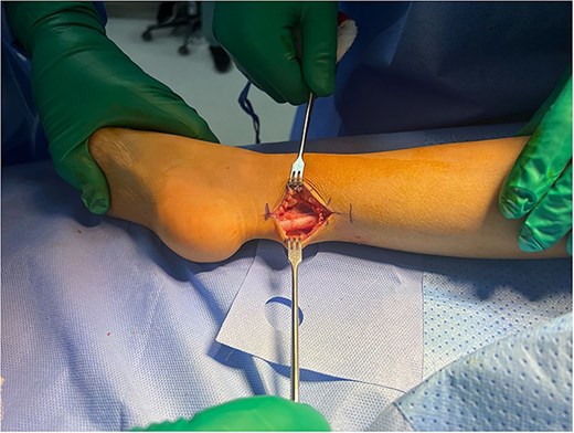 Achilles tendon exposed for Z-lengthening.