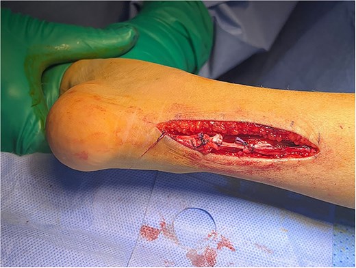 Tendoachillis after lengthening, showing improved dorsiflexion.