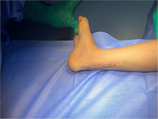 After lengthening passive dorsiflexion reaching 20°.