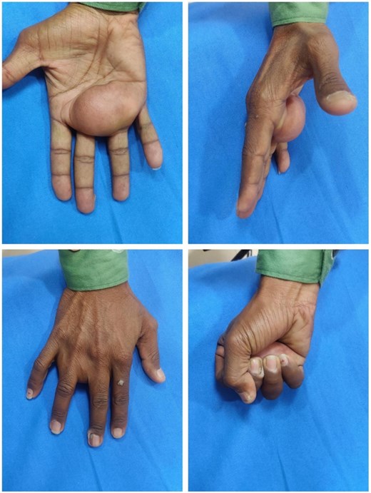 Preoperative clinical photographs showing a large, dome-shaped swelling in the central palm (top left), palmar projection from the lateral view (top right), and mild extension over the dorsum (bottom left). Grip weakness is evident on fist closure (bottom right).
