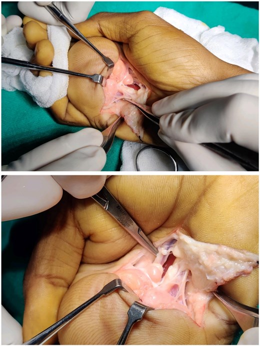 Intraoperative views showing deep dissection within the palmar space. The lipoma is identified closely adherent to flexor tendons and neurovascular structures, requiring meticulous dissection for en bloc removal.