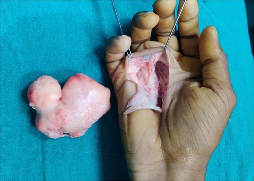 Gross specimen and post-excision cavity: A multilobulated, well-encapsulated yellow lipomatous mass measuring approximately 7 × 6 × 4 cm, shown next to the exposed deep palmar space after excision.