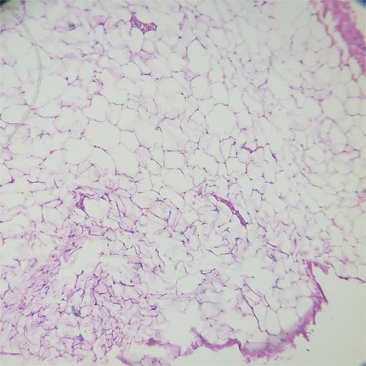 Histopathological section showing mature adipocytes arranged in lobules separated by thin fibrovascular septa, consistent with lipoma (H&E, 10×).
