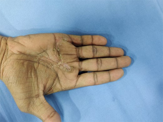 Postoperative clinical photograph at follow-up showing a well-healed surgical scar in the palmar region with complete restoration of hand contour and no residual swelling or deformity.