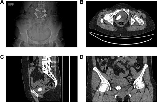 The preoperative imaging examinations of the patient. (A) The plain film of kidney–ureter–bladder. (B–D) Computed tomography.