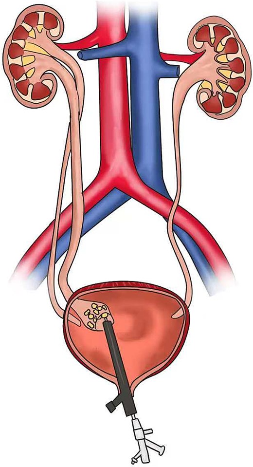 Schematic diagram of the surgery process.
