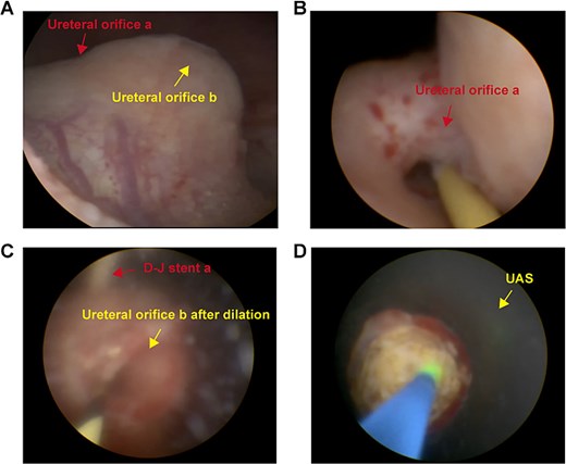Intraoperative images revealing duplex ureter with ureterocele harboring multiple large stones. Multiple stones were discovered at the opening of ureter b and the surgery was assisted by UAS.