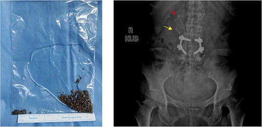 Postoperative stone display and KUB imaging examination.