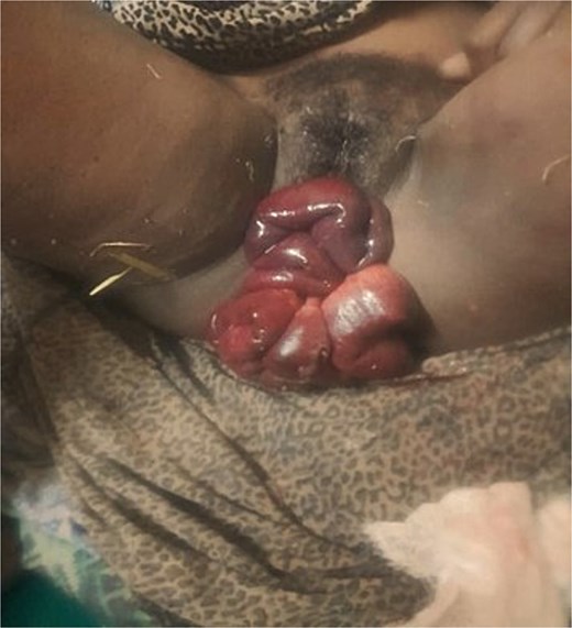 Complete herniation of gangrenous small bowel eviscerated through the self-amputated UVP.