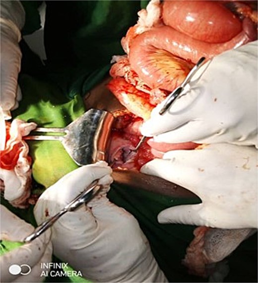 Anterior lower uterine body defect resulted from the self-attempted amputation of UVP.
