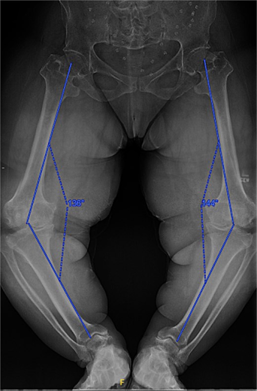 Preoperative standing AP radiographs demonstrating severe bilateral mechanical axis varus deformity measuring 36 and 44 degrees on the left and right legs, respectively.