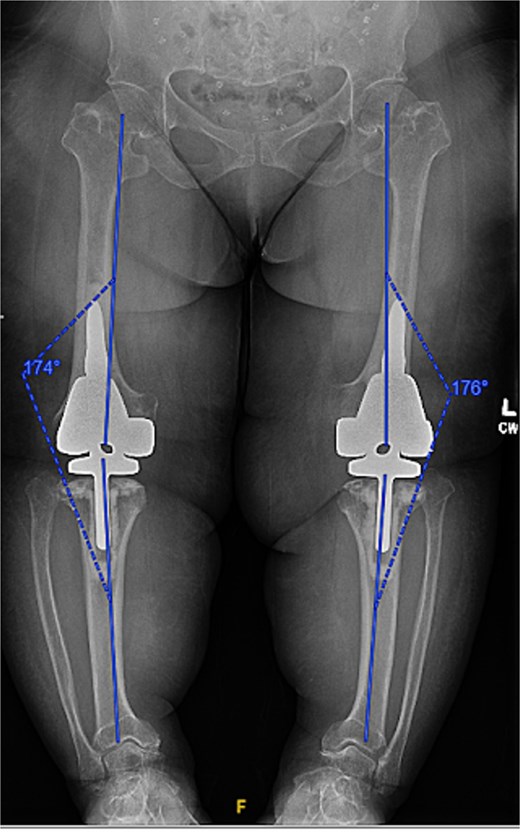 Immediate postoperative AP radiographs following bilateral robot-assisted rotating-hinge TKA, showing well-aligned prosthetic components and correction of the coronal deformity. The post-operative mechanical axis for the left and right knees were 4 and 6 degrees, respectively.