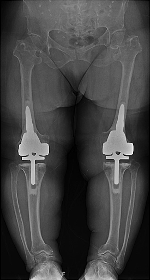 Two-year postoperative AP radiographs demonstrating stable, well-fixed components with appropriate alignment and no evidence of implant loosening or periprosthetic lucency.