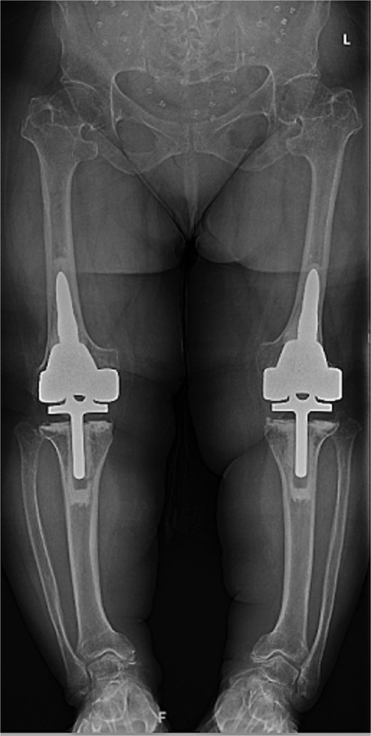 Five-year postoperative AP radiographs showing continued stability of bilateral rotating-hinge implants with maintained alignment and no radiographic evidence of implant failure.