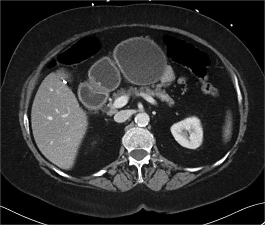 CT scan A/P of the abdomen and pelvis with IV contrast on presentation showing moderately dilated gastric remnant with thickening of the pylorus and proximal duodenum.