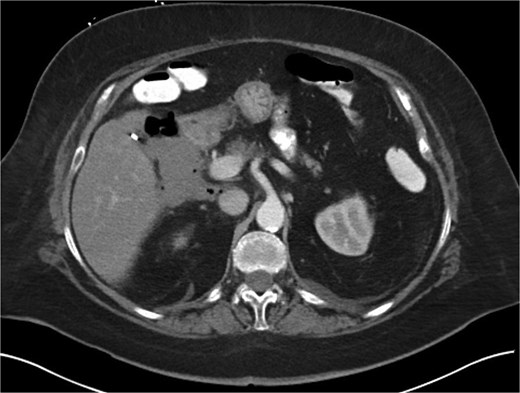 Hospital Day 4 CT scan of the abdomen and pelvis A/P with oral and intravenous contrast demonstrating scattered pneumoperitoneum and free fluid by lateral duodenum.