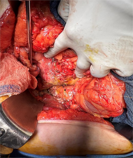 Intra-operative image showing primary repair of D3 duodenal perforation.