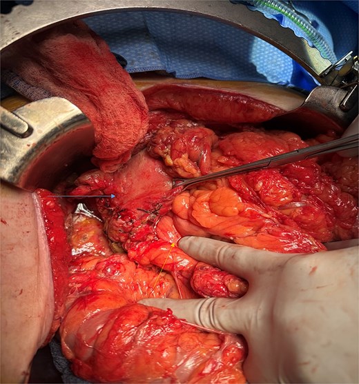 Intra-operative image showing pyloroplasty and omental patch repair.
