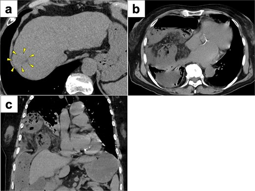 CT images of preoperative examinations. (a) Pre-RFA CT showing that HCC was a 20-mm lesion located in the subcapsular portion of hepatic Segment 8 (arrow). (b and c) Axial and coronal abdominal CT showing incarceration of the transverse colon into the thoracic cavity.