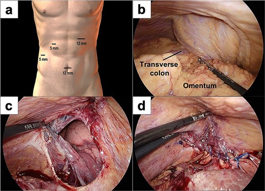 Intraoperative images of laparoscopic surgery. (a) Placement of the laparoscopy trocars. (b) The transverse colon and omentum were found incarcerated in the right diaphragmatic hernia. (c and d) A 50 × 50 mm diaphragmatic defect was identified and closed using barbed sutures.