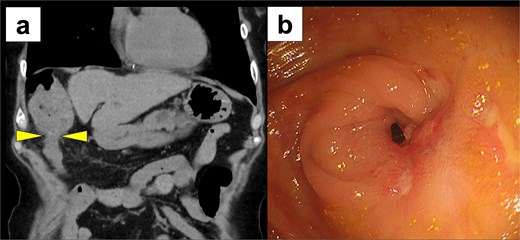 Postoperative imaging studies. (a) CT scan showing stenosis of the transverse colon with massive fecal impaction in the ascending colon (arrow) and massive fecal impaction in the ascending colon. (b) Lower gastrointestinal endoscopy revealing severe stenosis at the hepatic flexure of the transverse colon.
