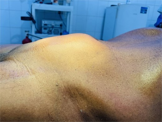 Preoperative clinical photograph of the patient showing visible suprapubic abdominal swelling extending up to the umbilicus (arrow).