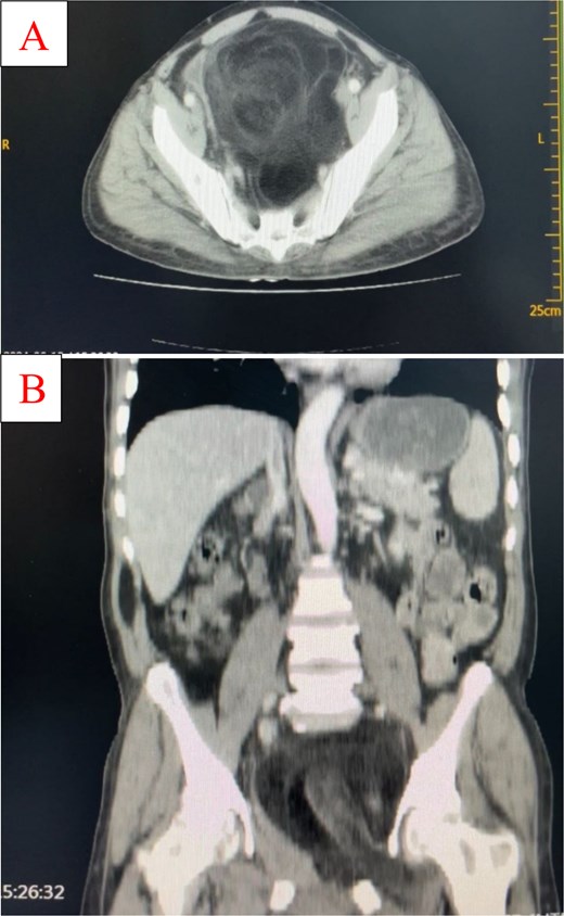 Coronal (A) and sagittal (B) CT images demonstrating a large retroperitoneal fatty mass with central soft tissue density. The mass extends through the left obturator and right greater sciatic foramina, displacing the bladder anteriorly and pelvic organs laterally.