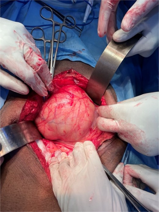 Intraoperative photograph showing the well-encapsulated giant retroperitoneal lipoma being mobilized during laparotomy.