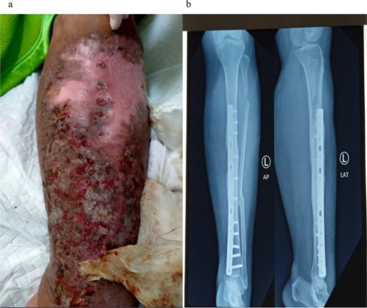 Clinical presentation of patient upon admission before implant removal surgery (a); The X-ray result taken on the same day, shows the implant in place (b).
