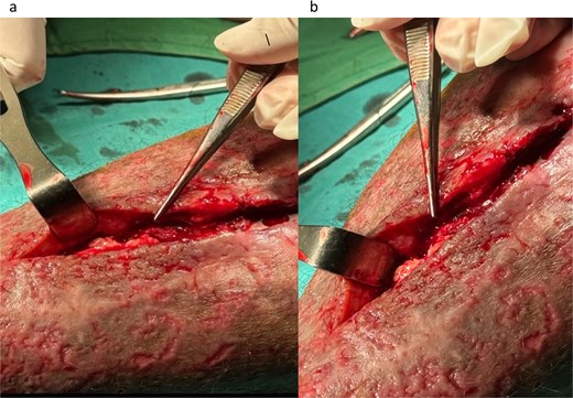 Infected tissue surrounding the implant as observed during surgery (a and b).