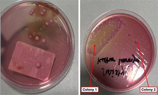 Different phenotypes of Klebsiella pneumoniae on MacConkey agar were isolated from various specimens in the same patients. The colonies from the tissue specimen (a), along with the mucoid (colony 1) and non-mucoid (colony 2) colonies from the implant specimen (b), may indicate biofilm formation on the implant surface.