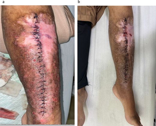 Clinical appearance of the surgical site 2 days after implant removal surgery (a); and 1 week post-surgery (b), showing progression in wound healing and resolution of infection signs.