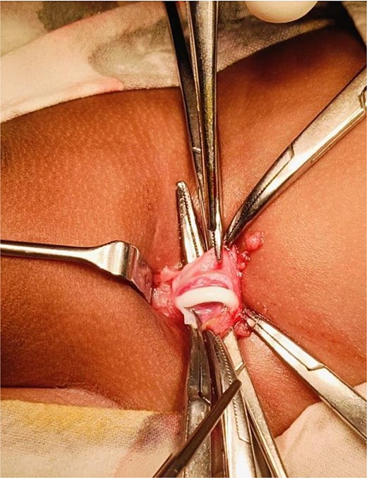 Intraoperative image showing VP shunt entering the scrotum.