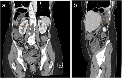 CT with a) coronal and b) sagittal slices demonstrating right sided posterolateral diaphragmatic defect containing incarcerated small bowel.