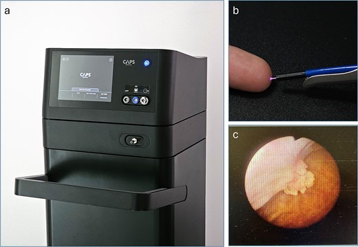 (a) The PlasmaSure™ console, operated using a touchscreen interface. It generates and monitors the PlasmaSure™ parameters and gas flow during the clinical procedure. (b) The PlasmaSure™ probe applied through a working channel of the 22 Fr cystoscope. (c) A cystoscopy image of the treated tumor at baseline.