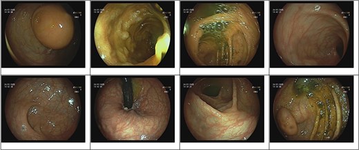 Colonoscopy image demonstrating a submucosal lesion at the cecal base, suggestive of an appendiceal origin.