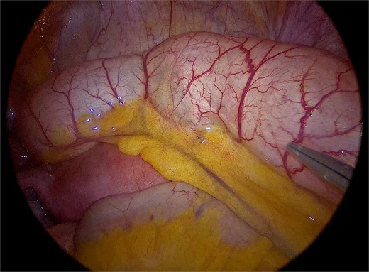 Laparoscopic view demonstrating the markedly distended appendix consistent with a giant mucocele.