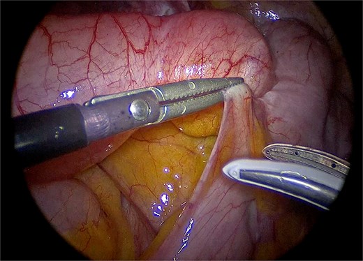 Careful laparoscopic dissection of the appendiceal base, with meticulous attention to avoid rupture of the specimen.