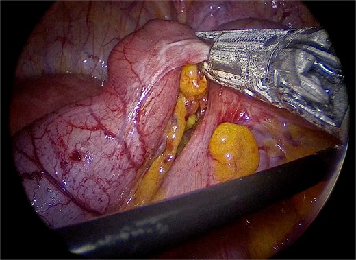 Division of the appendiceal base with an Endo-GIA stapler, including the cecal base while preserving the ileocecal valve.