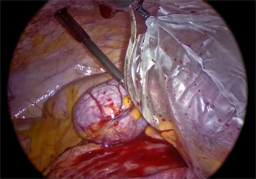 Intact retrieval of the specimen within an endoscopic bag through the umbilical incision to prevent rupture or intraperitoneal spillage.