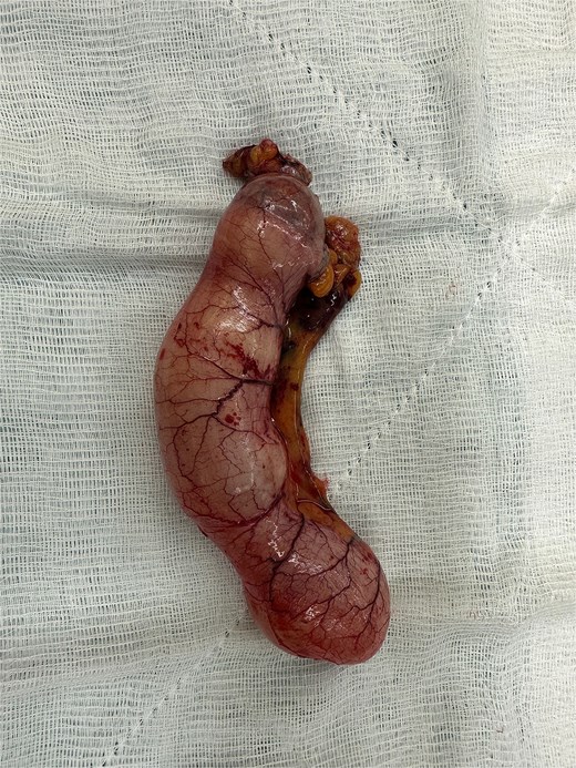 Gross specimen of the resected appendix measuring approximately 17 cm in length, consistent with a giant appendiceal mucocele.
