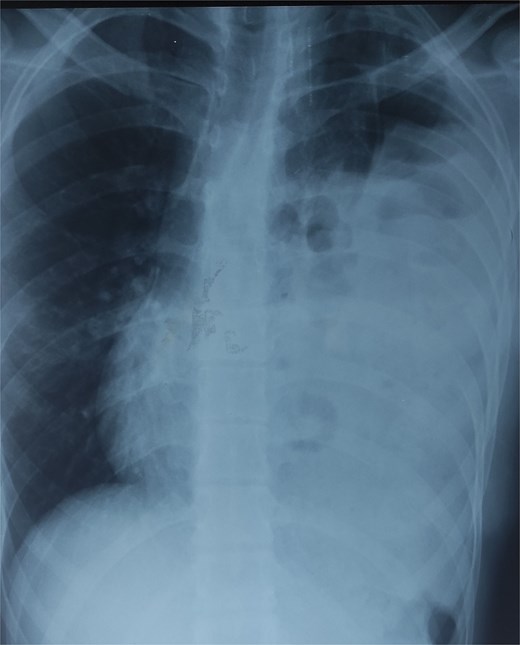 Chest X-ray showing air-filled bowel loops within the left hemithorax.