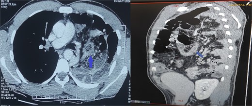 Contrast-enhanced CT of the chest and abdomen showing a left posterolateral diaphragmatic hernia with herniation of bowel and omentum into the thorax. The thickened appendix with surrounding fat stranding indicates acute appendicitis.