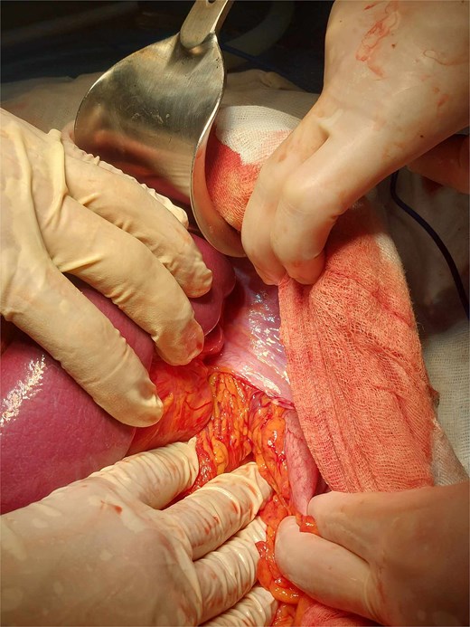Left posterolateral diaphragmatic defect with herniated bowel and omentum.